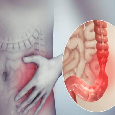 اعراض القولون العصبي عند النساء
