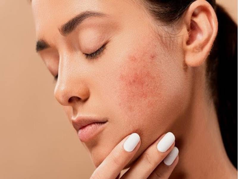 علاج حب الشباب لماذا أعاني منه ميديكال واي Medicalway