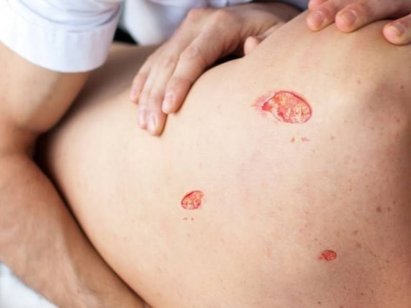 علاج قرح الفراش لكبار السن كيف يمكن الوقاية منها؟ ميديكال واي