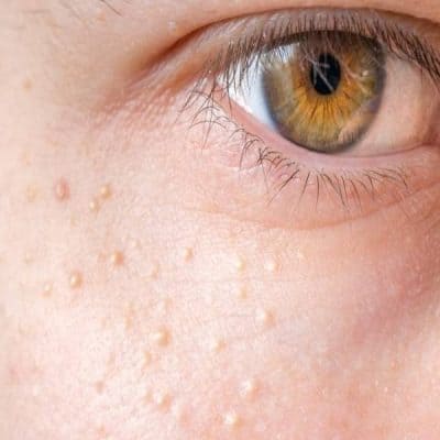 علاج الحبوب البيضاء تحت العين
