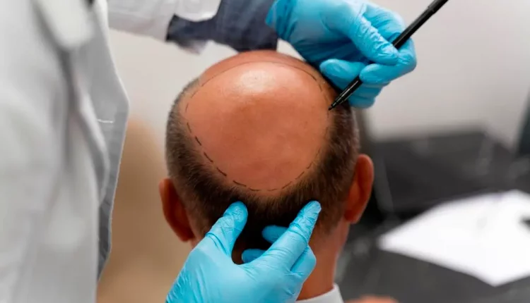 زراعة الشعر | الفوائد والأضرار وأحدث التقنيات المستخدمة