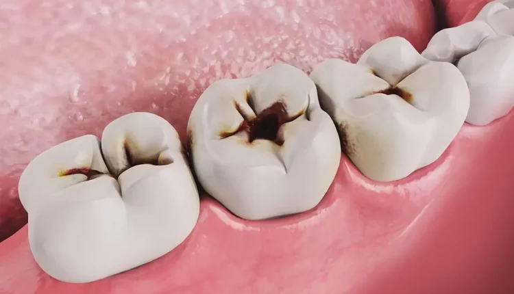تسوس الاسنان