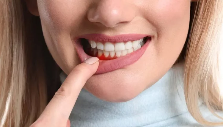 علاج التهاب اللثة