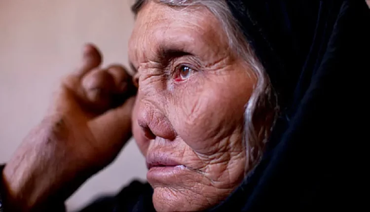 مرض الجذام