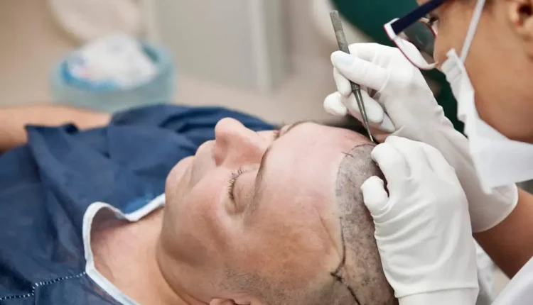زراعة الشعر | الفوائد والأضرار وأحدث التقنيات المستخدمة