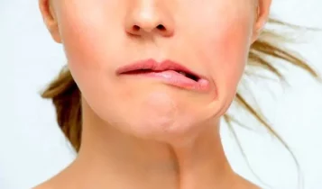 اعراض العصب السابع