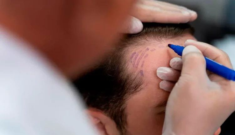 زراعة الشعر | الفوائد والأضرار وأحدث التقنيات المستخدمة